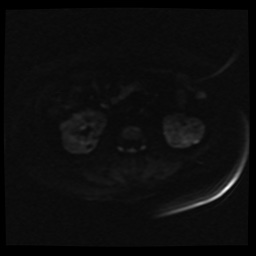 Adult polycystic kidney disease (Radiopaedia 59075-66365 Axial DWI 41).jpg