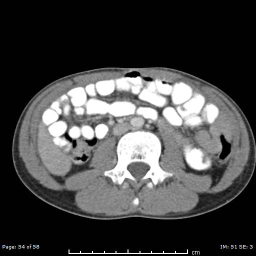 Agenesis of the gallbladder (Radiopaedia 55454-61905 B 54).jpg