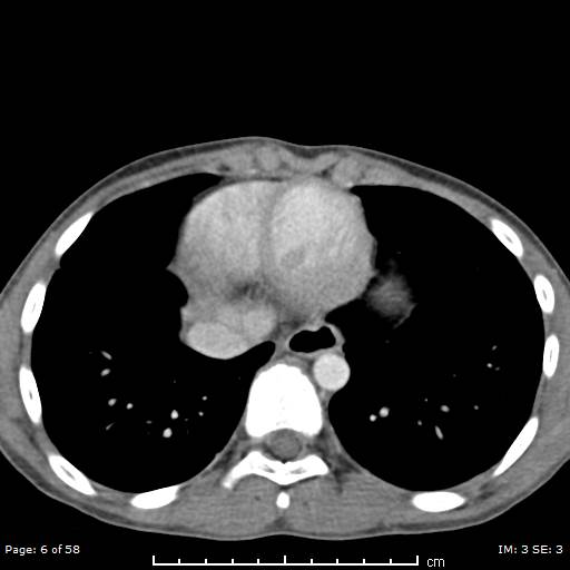 File:Agenesis of the gallbladder (Radiopaedia 55454-61905 B 6).jpg