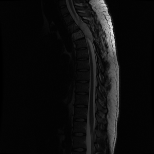 File:Aggressive vertebral hemangioma (Radiopaedia 39937-42404 Sagittal T2 8).png