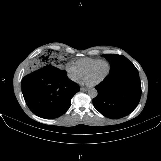 Air bronchogram in pneumonia (Radiopaedia 85719-101512 Axial non-contrast 49).jpg