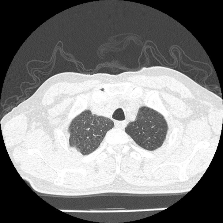 Airway foreign body in adult (Radiopaedia 85907-101779 Axial lung window 4).jpg