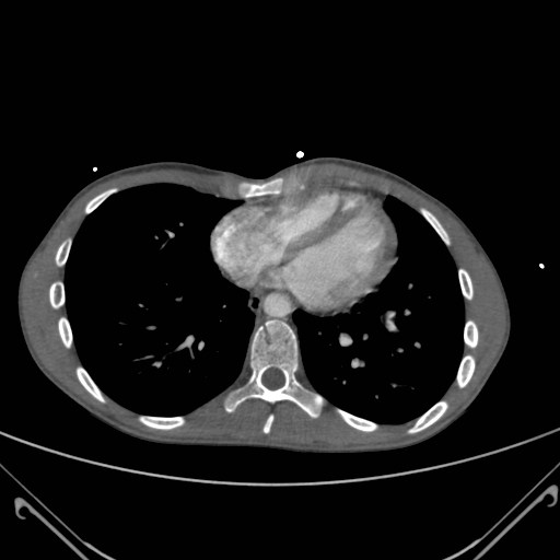 File:Alagille syndrome with pulmonary hypertension (Radiopaedia 49384-54980 A 10).jpg