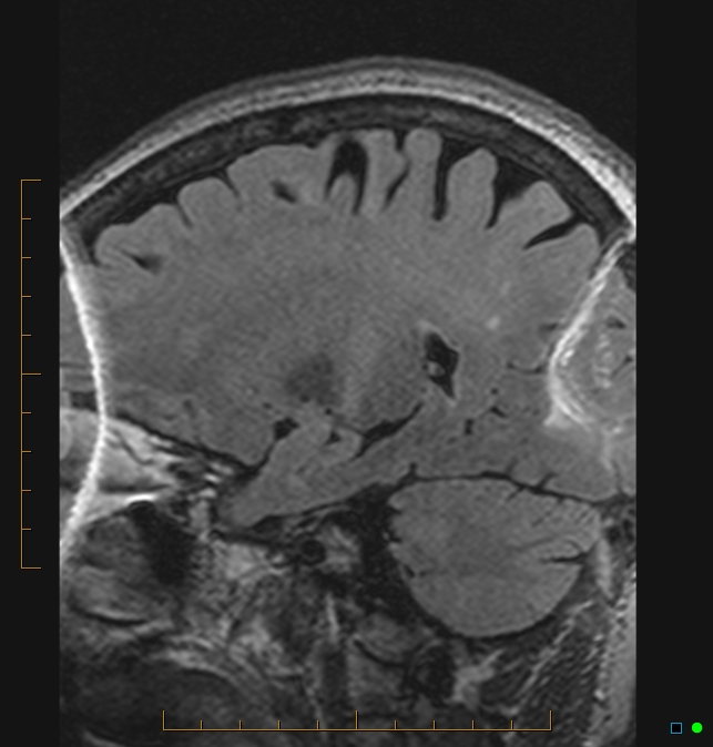 Aliasing artifact causing a spurious cerebellar lesion (Radiopaedia 48783-53810 Sagittal FLAIR 78).jpg