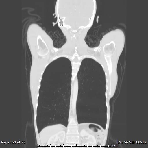 Alpha-1-antitrypsin deficiency (Radiopaedia 50561-55987 Coronal lung window 48).jpg