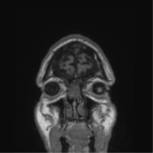 Alzheimer's disease- with Gerstmann syndrome and dressing apraxia (Radiopaedia 54882-61150 Coronal T1 86).png