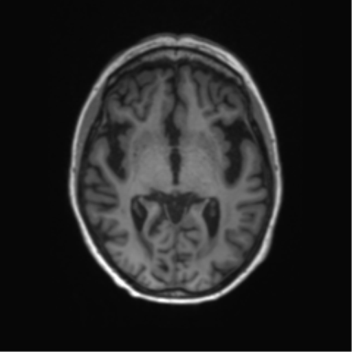 File:Alzheimer's disease (Radiopaedia 42658-45802 Axial T1 85).png