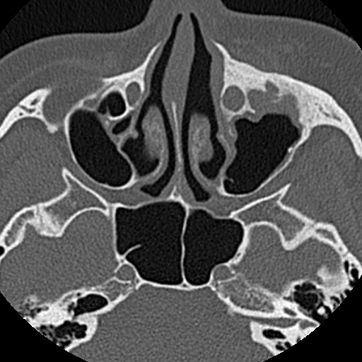 File:Ameloblastic fibro-odontoma (Radiopaedia 18843-18780 C 8).jpg