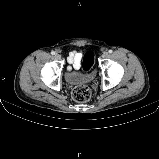 Ampullary adenocarcinoma (Radiopaedia 86093-102032 A 52).jpg