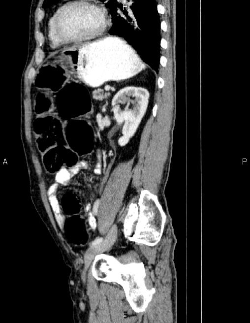 Ampullary adenocarcinoma (Radiopaedia 86093-102032 D 67).jpg
