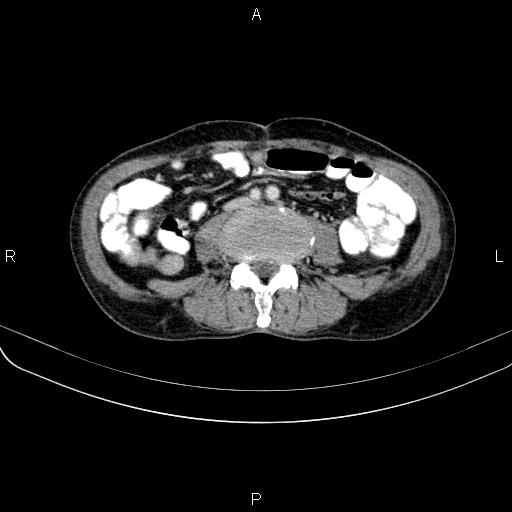 Ampullary adenocarcinoma (Radiopaedia 86093-102033 B 79).jpg