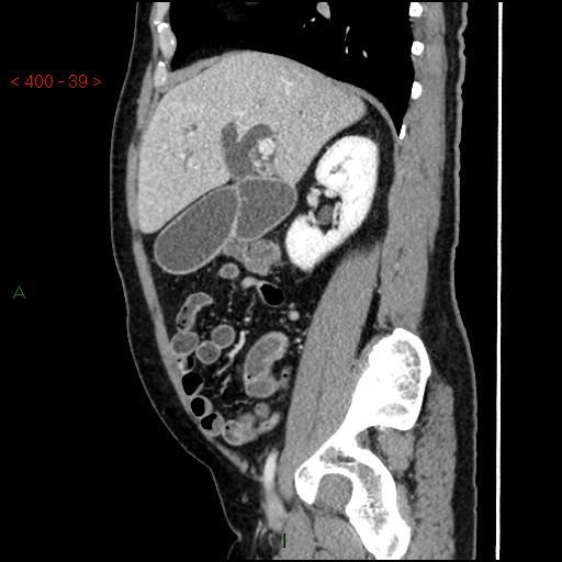 Ampullary carcinoma (Radiopaedia 56396-63056 D 38).jpg
