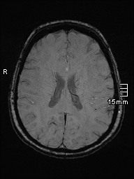 Amyotrophic lateral sclerosis (Radiopaedia 70821-81017 Axial SWI 33).jpg