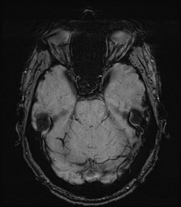 Amyotrophic lateral sclerosis (Radiopaedia 87352-103658 Axial SWI 15).jpg