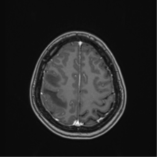 Anaplastic astroblastoma (Radiopaedia 55666-62194 Axial T1 C+ 60).png