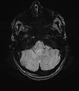 File:Anaplastic astrocytoma IDH mutant (Radiopaedia 50046-55341 Axial SWI 19).png