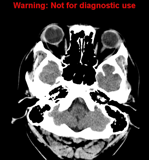 File:Anaplastic ganglioglioma (Radiopaedia 44921-48815 Axial non-contrast 4).jpg