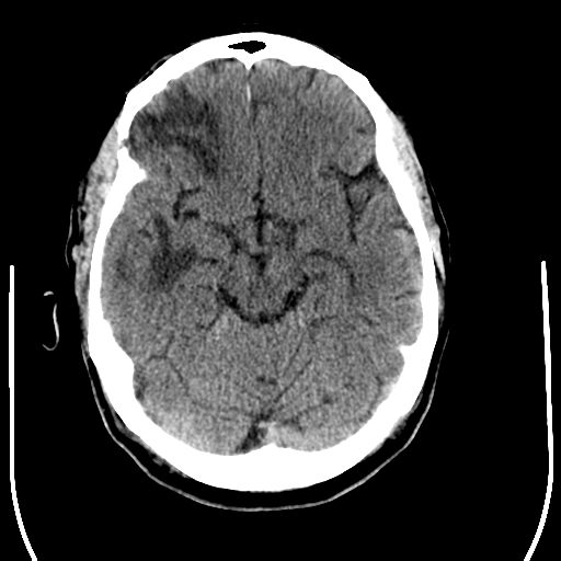 File:Anaplastic meningioma with recurrence (Radiopaedia 34452-35781 Axial non-contrast 13).png