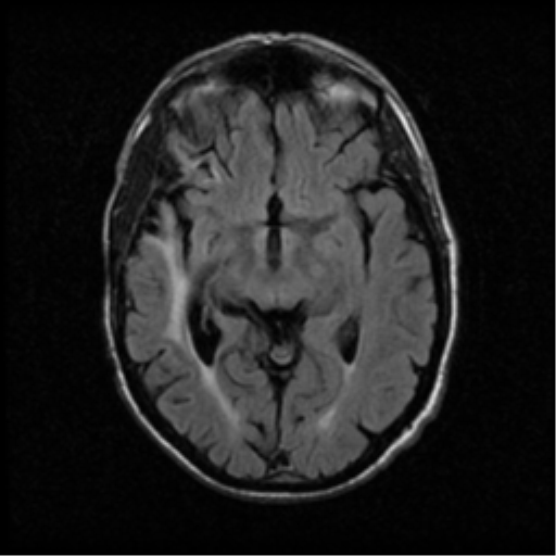 File:Anaplastic meningioma with recurrence (Radiopaedia 34452-35789 Axial FLAIR 11).png