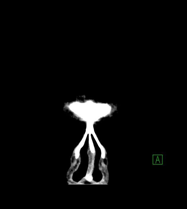 Anaplastic oligodendroglioma (Radiopaedia 79571-92758 Coronal non-contrast 5).jpg