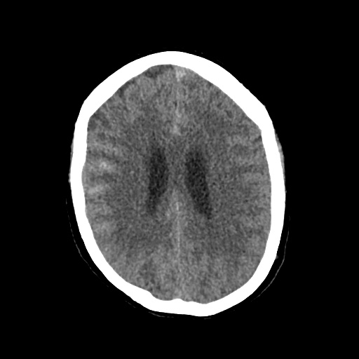 File:Aneursym related subarachnoid hemorrhage with hydrocephalus (Radiopaedia 45105-49083 Axial non-contrast 32).jpg
