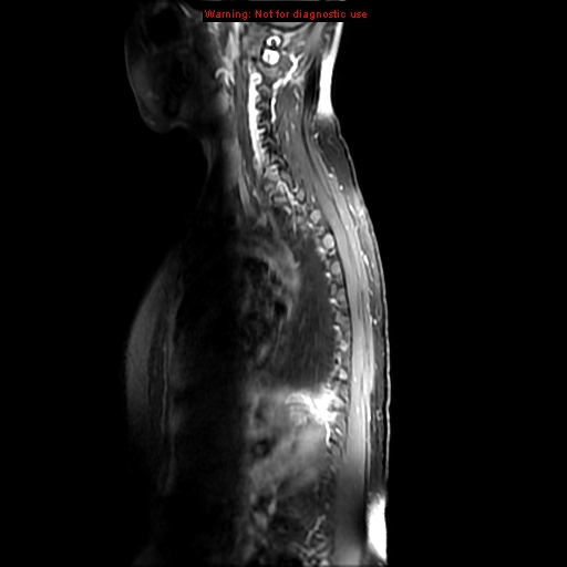 File:Aneurysmal bone cyst (Radiopaedia 9419-10103 Sagittal T1 fat sat 11).jpg