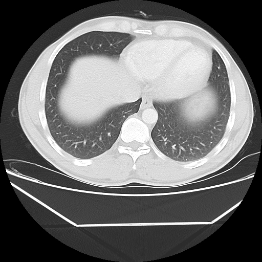 File:Aneurysmal bone cyst - rib (Radiopaedia 82167-96220 Axial lung window 50).jpg