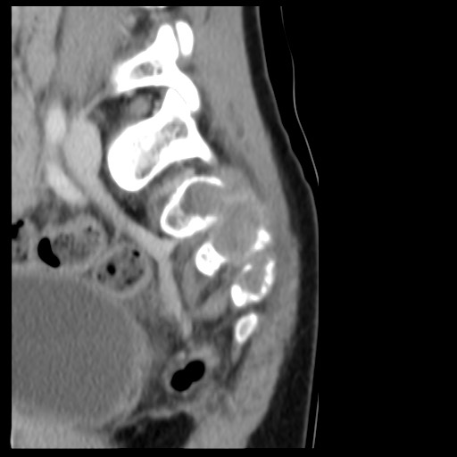 File:Aneurysmal bone cyst - sacrum (Radiopaedia 65190-74195 A 8).jpg