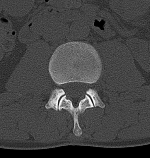 Aneurysmal bone cyst T11 (Radiopaedia 29294-29721 Axial bone window 84).jpg