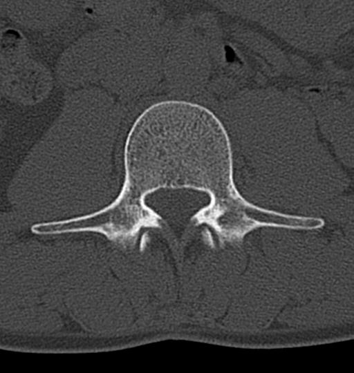 Aneurysmal bone cyst T11 (Radiopaedia 29294-29721 Axial bone window 87).jpg