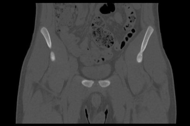 File:Aneurysmal bone cyst of ischium (Radiopaedia 25957-26094 Coronal bone window 8).png