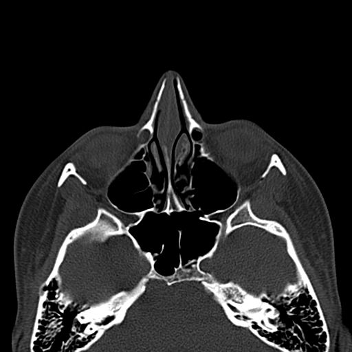 Aneurysmal bone cyst of the mandible (Radiopaedia 43280-46601 Axial bone window 87).jpg