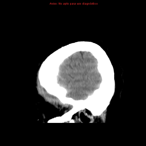 File:Aneurysmal subarachnoid hemorrhage (Radiopaedia 24740-24997 non-contrast 48).jpg