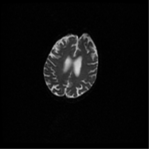 Angioinvasive aspergillosis in the pituitary fossa (Radiopaedia 39676-42010 Axial DWI 64).png