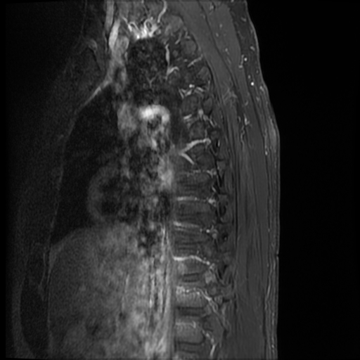 File:Angiolipoma - thoracic spine (Radiopaedia 28242-28479 E 13).jpg