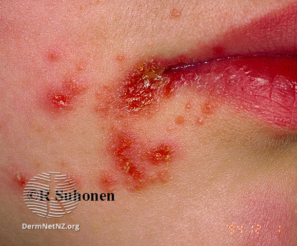 File:Angular cheilitis (DermNet NZ site-age-specific-s-perleche17).jpg