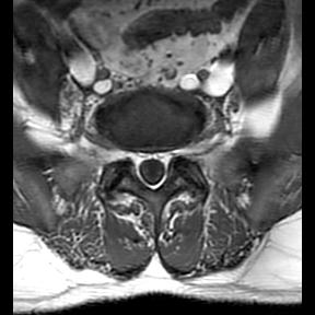 File:Ankylosing spondylitis with zygapophyseal arthritis (Radiopaedia 38433-40516 Axial T1 2).jpg