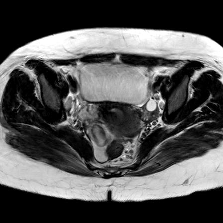 File:Ano-vaginal fistula (Radiopaedia 29765-30284 Axial T2 19).jpg