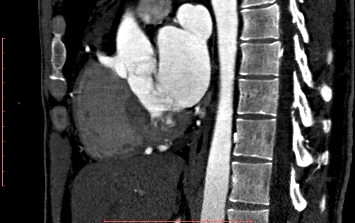 Anomalous left coronary artery from the pulmonary artery (ALCAPA) (Radiopaedia 70148-80181 C 118).jpg