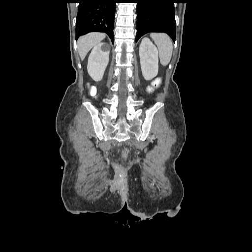 Anorectal carcinoma (Radiopaedia 44413-48064 B 69).jpg