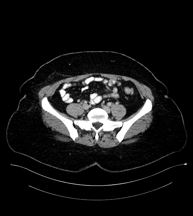 Anterior abdominal wall CSF pseudocyst (CSFoma) (Radiopaedia 79453-92571 A 65).jpg