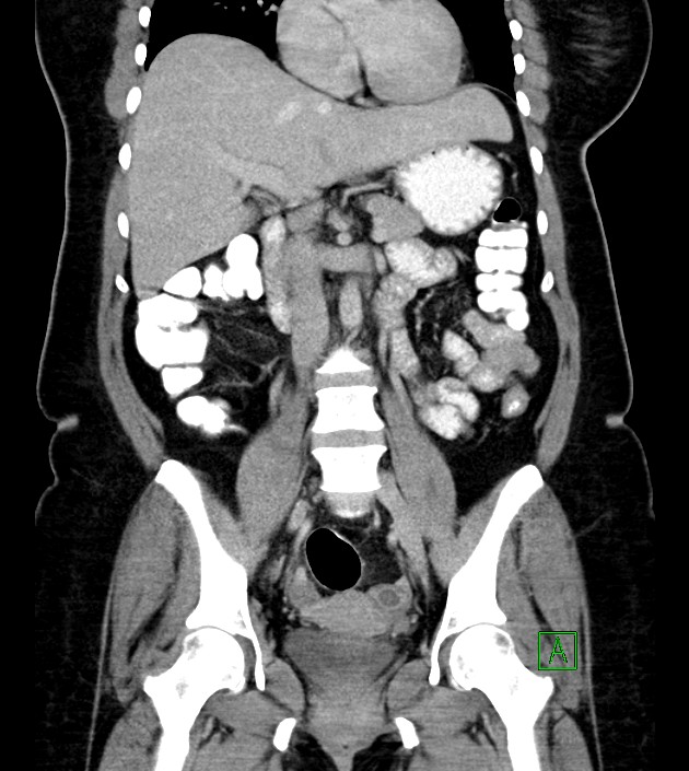 Anterior abdominal wall CSF pseudocyst (CSFoma) (Radiopaedia 79453-92571 B 30).jpg