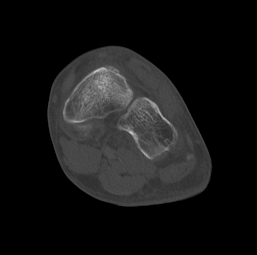 File:Anterior calcaneal process fracture (Radiopaedia 47384-51989 Coronal bone window 48).png
