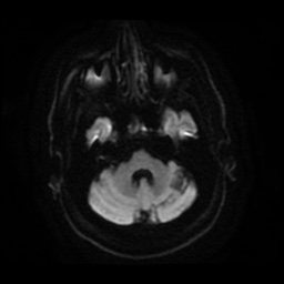 Anterior cerebral artery infarction (Radiopaedia 46794-51323 Axial DWI 8).jpg