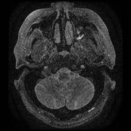 Anterior cerebral artery infarction (Radiopaedia 46794-51323 Axial MRA 1).jpg