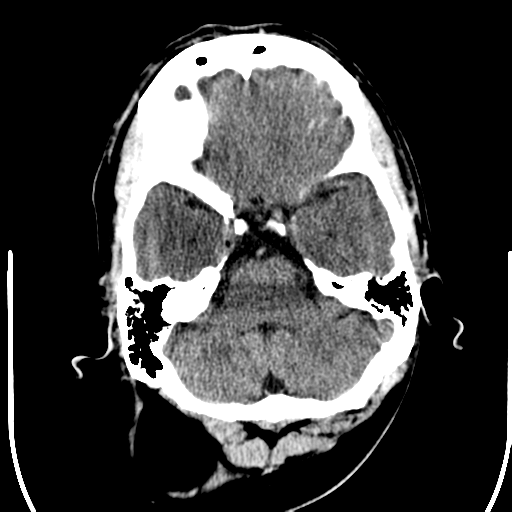 File:Anterior cerebral artery territory infarct (Radiopaedia 39327-41581 Axial non-contrast 7).png