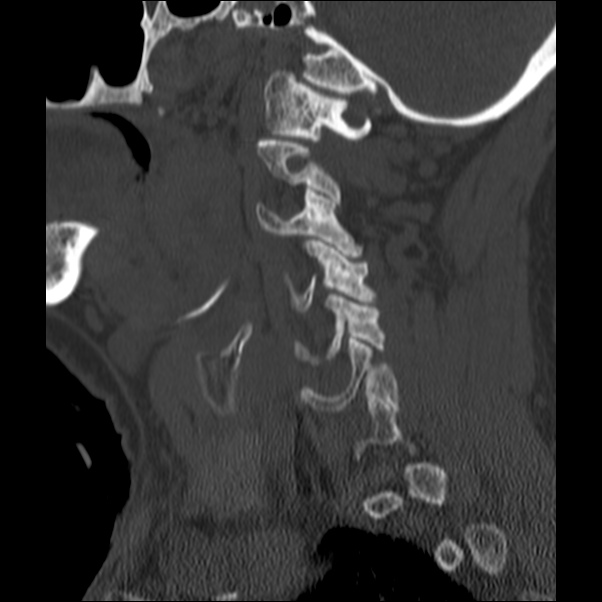 Anterior cervical postdiscectomy arthrodesis (Radiopaedia 32678-33646 Sagittal bone window 17).jpg