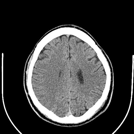 Anterior choroidal artery infarct (Radiopaedia 55106-61480 Axial non-contrast 41).jpg