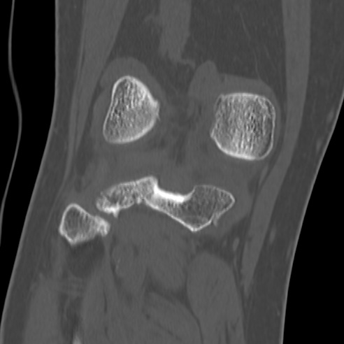 File:Anterior cruciate ligament avulsion fracture (Radiopaedia 58939-66194 Coronal bone window 26).jpg
