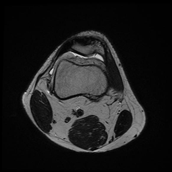 File:Anterior cruciate ligament graft tear and bucket-handle tear of medial meniscus (Radiopaedia 75867-87254 Axial T2 23).jpg
